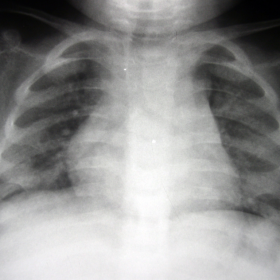 Frontal radiograph of the chest
