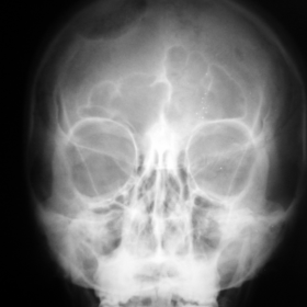 Skull radiograph