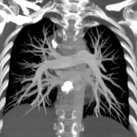 CT pulmonary angiography