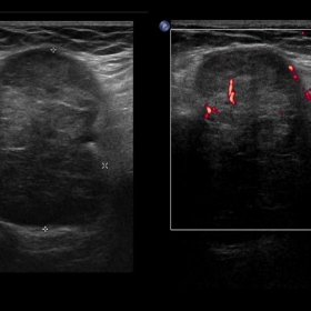 Ultrasound and Doppler ultrasound study