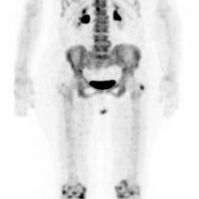 18F-NaF PET/CT shows symmetric tracer uptake in bilateral frontal region (arrows) on MIP image