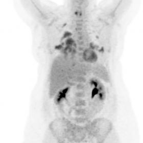 Maximum intensity projection (MIP) image demonstrating significant peripheral lung uptake