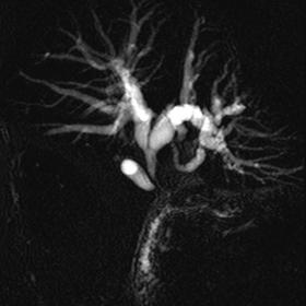 MR cholangio pancreatography shows a long stenosis of the common bile duct involving the anastomotic site, with symmetric ups