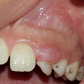 Intraoral view: Buccal swelling, displacement of teeth 21 and 22, and persistence of the left lacteal canine