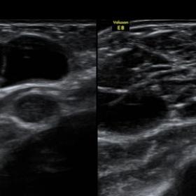 Ultrasound  examination of bilateral breast showed well circumscribed relatively symmetrical complex cystic lesions showing i