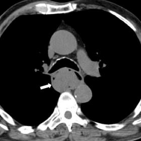 CT in the axial plane without contrast (A) showed an esophageal mass with endoluminal growth. The images obtained after admin