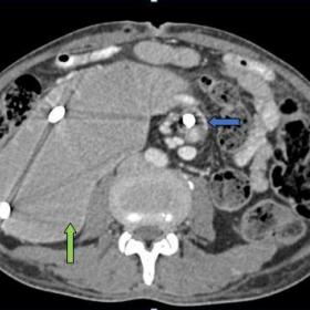 Contrast enhanced abdominal CT axial imaging: Midgut volvulus (blue arrow) and upstream dilatation of duodenal loop (Green co