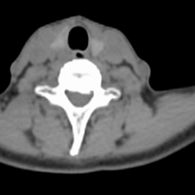 Low-dose CT of the neck