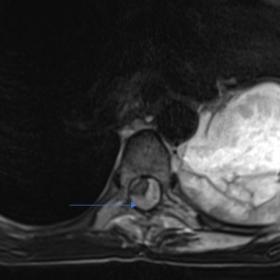 Axial T2 weighted image through the chest shows a lobulated high signal intensity lesion at the left side of the posterior me