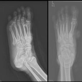 Closed degloving injury of the fifth toe is identified with overlying soft tissue swelling. Subtle fractures of the distal ph