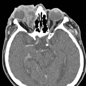 Axial contrast enhanced CT of the orbits demonstrates a periorbital soft-tissue formation infiltrating both eyelids and the m