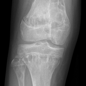 AP radiograph of the right knee showing numerous lobulated osteolytic lesions surrounded with sclerotic border and pathologic
