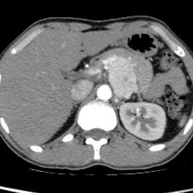 Axial CT scan image in arterial phase shows hyperenhancing lesion arising from the medial limb of left adrenal gland measurin