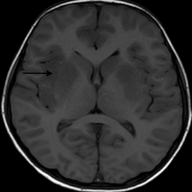 T1 weighted axial MRI image at the level of basal ganglia showing hypo intensity(black arrow) in bilateral basal ganglia and 