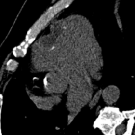 MPR images of the CT scan shows the presence of lobulated, thin-walled cyst, with spotty peripheral calcification (a), locali