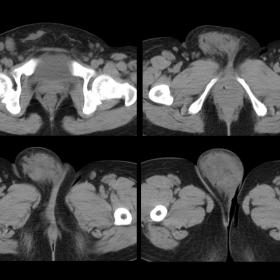 Computed tomography (CT) images show a subcutaneous isodense mass  (arrows) with an irregular margin and regional lymphadenop