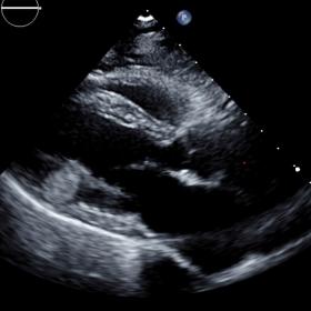 Long-axis view echocardiogram demonstrates a rounded echogenic mass measuring 16 x 16 mm in the mid posterior left ventricula