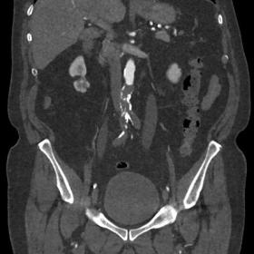 CTA showing complete occlusion of the infrarenal segment of the aorta and bilateral occlusion of the common iliac arteries