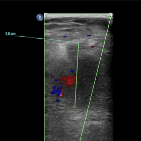 Right popliteal fossa ultrasound: pseudocystic mass with some internal color Doppler signal