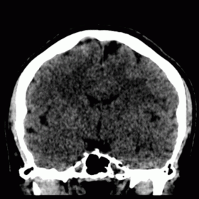 (a) Coronal non-enhanced brain CT showing a small focus of SAH in the right frontal giri. (b) Axial post-contrast head CT rev