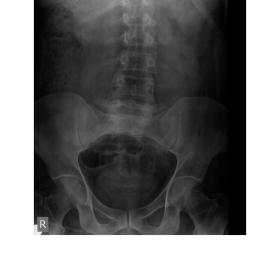 Conventional X-ray urinary tract A-P projection showed no radio-opaque renal, ureteral or urinary bladder calculi