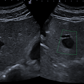 Ultrasound images performed with a 4 MHz convex probe. Cystic lesion in liver segment IVa, with well-defined and slightly lob