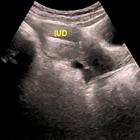 Sagittal gray-scale ultrasound image through the pelvis shows a correctly positioned intrauterine device.. The gestational sa