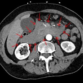 Abdominal Contrast-enhanced CT scan in the arterial phase shows a large retroperitoneal hematoma in the epigastric region wit