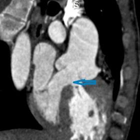 Coronal oblique image shows a subaortic ventricular septal defect measuring ~2.7cm (blue arrow)