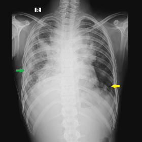 Chest Radiograph (PA view) demonstrates a large ill-defined mass occupying the mediastinum with poorly maintained margins wit