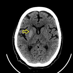 Non-contrast CT Brain showed hyperdensity involving right lentiform nucleus
