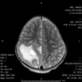 Axial T2WI: Shows a large Parietal lobe area with signal and morphological abnormalities. The outer core represents a thicken