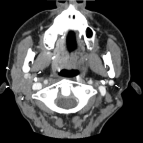 Contrast enhanced CT of the neck, axial view at the level of the mandibular rami