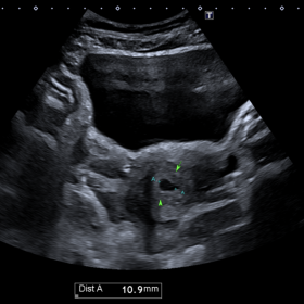 Ultrasound abdomen and pelvis demonstrating viable intrauterine gestational sac, measuring 10.9 mm.