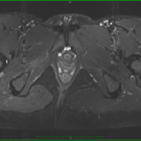 Axial T2-weighted fat-suppressed MR image shows no signs of predisposing damage of the external obturator muscle.