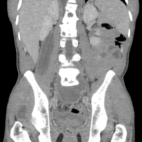 Enhanced coronal CT demonstrating large right psoas muscle fluid collection.