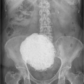 The abdominal radiograph shows a pelvic mass with a rounded border, constituted by dense and amorphous calcifications with a scattered popcorn appearance, compatible with calcified uterine leiomyoma