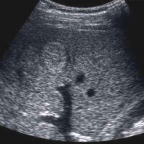 Ultrasonography of liver
