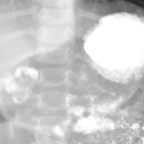 Conventional radiography with oral contrast