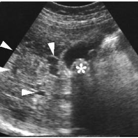 Ultrasonography (US) of the liver