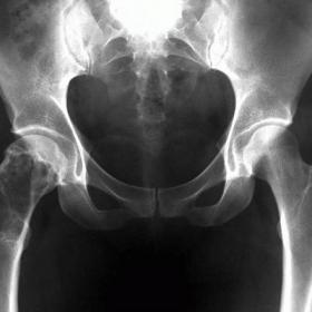Conventional X-Ray of the pelvic girdle. A-P projection.
