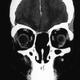CT study, 2 years after the end of the treatment