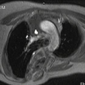 T1 weighted MR image after contrast media