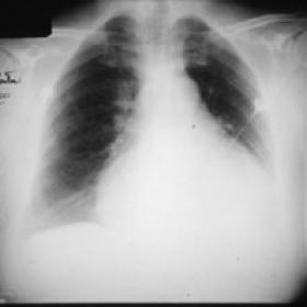 Postero anterior chest radiograph.