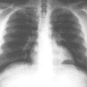 Chest X-Ray - AP