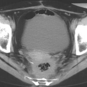 Computed Tomography (CT) of the pelvis