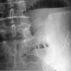Plain film shows distented small bowel loops and the migrated wallstent.