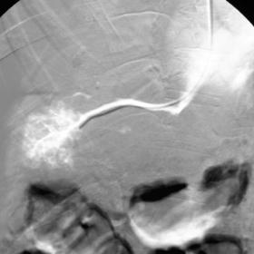 Wedged hepatic venography performed via the transjugular approach fails to depict the portal vein.