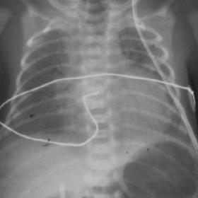 ACUTE RESPIRATORY DISTRESS DISEASE BEFORE THE APPAREANCE OF PNEUMOTHORAX