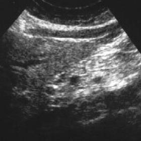 Abdominal ultrasonography performed before ERCP